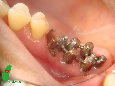 迷你多腳植牙串聯系統